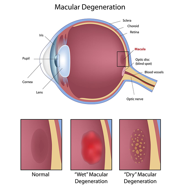 macular degeneration in paterson